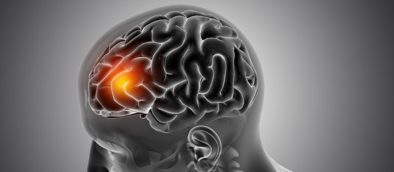 Δείκτης μάζας Σώματος και εγκεφαλικό - Μπακόπουλος Διαιτολόγος Αθήνα